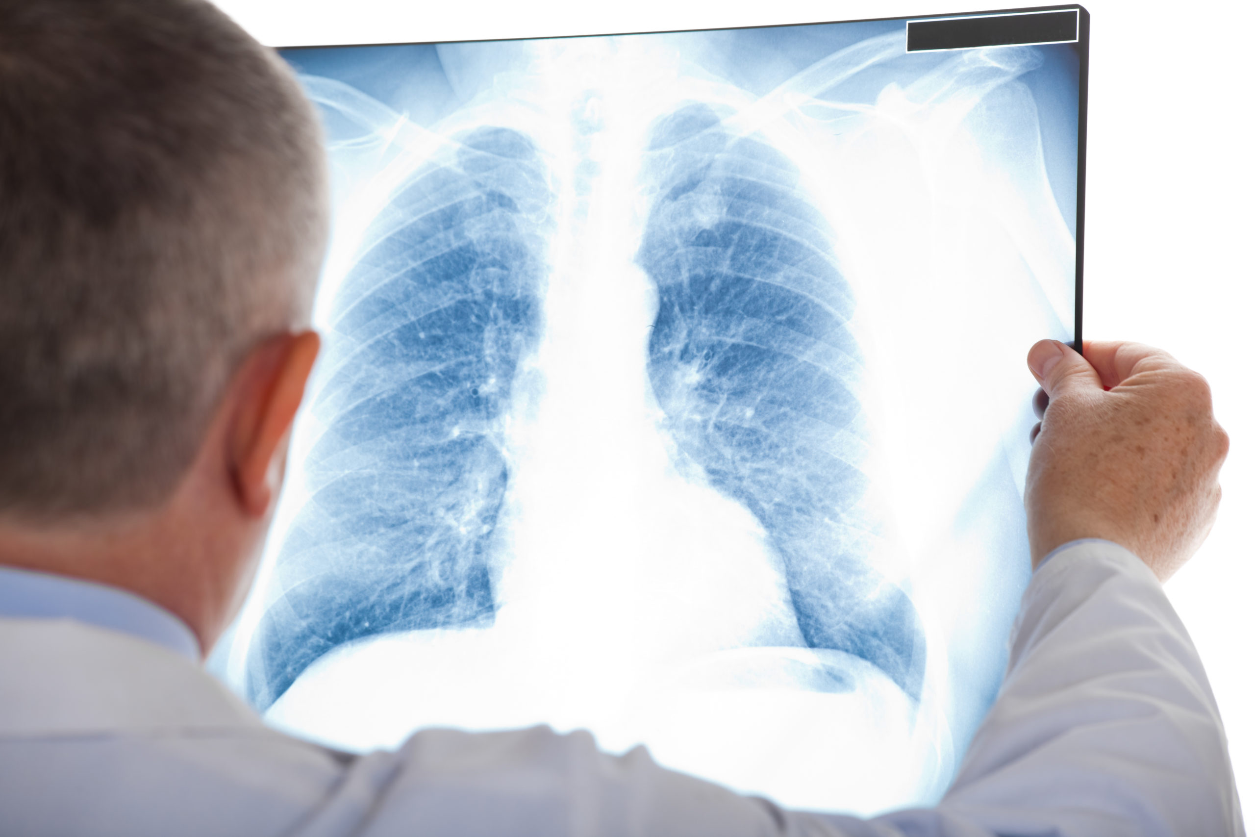Doctor examining a lung radiography - pneumonia