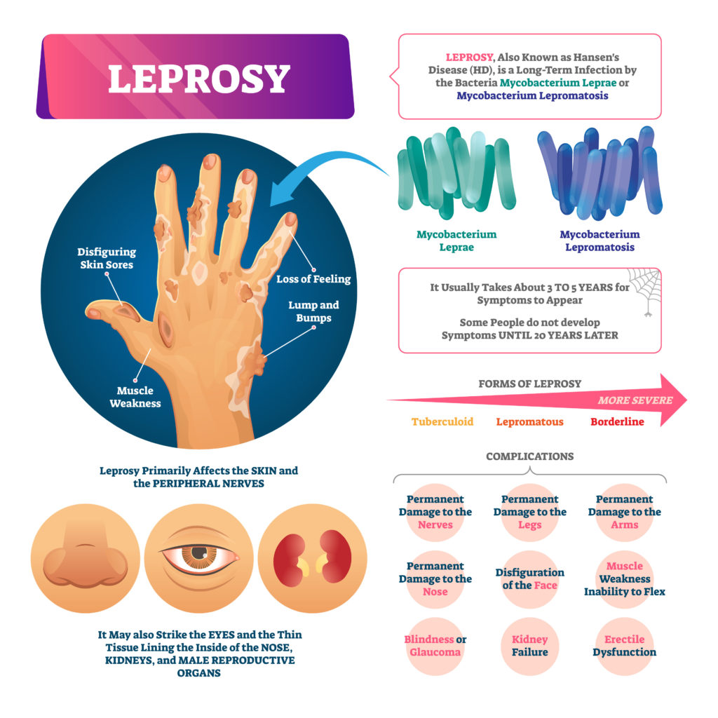 Leprosy medical bacterial infection disease.